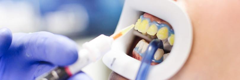 Bleaching, Zahnaufhellung in der Praxis